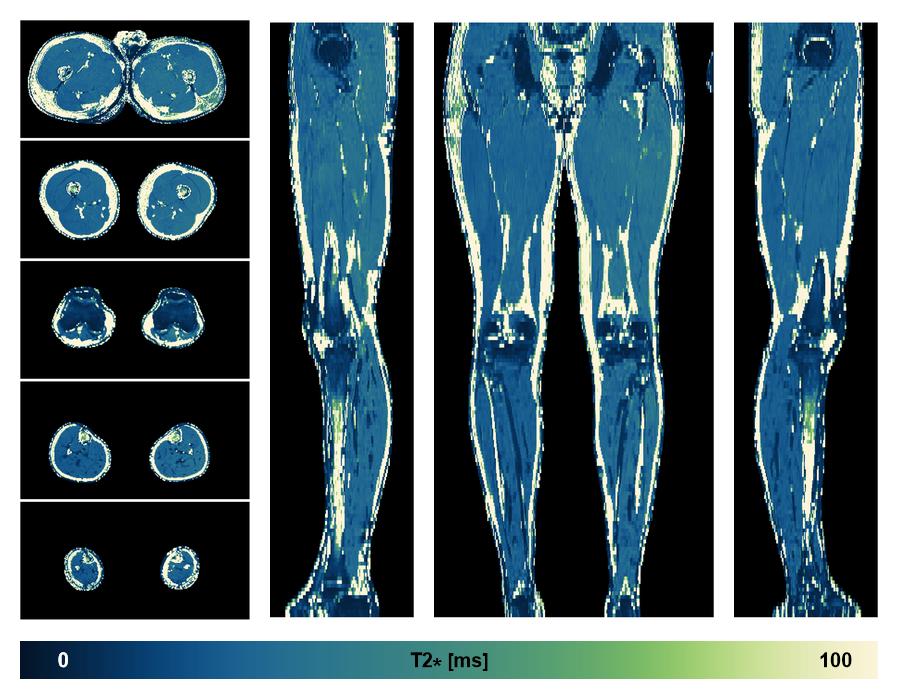 The T2 star relaxation time of the lower extremity obtained from the dixon reconstruction for muscle water fat quantification.